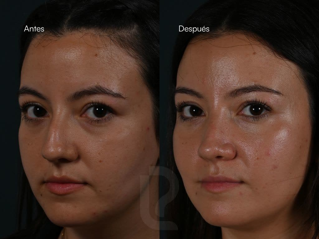 Rinoplastia caso 3