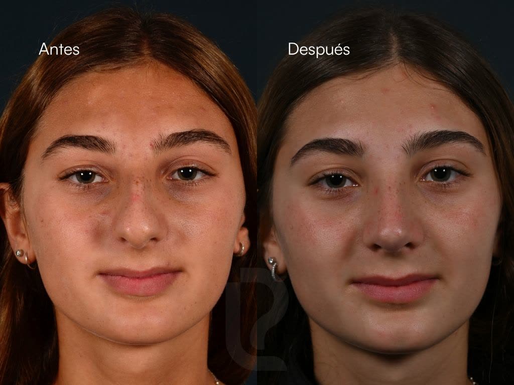 Rinoplastia caso 6
